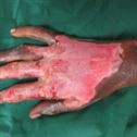 Quick-Tips-to-Treat-Fire-Burns-from-Crackers Quick Tips To Treat Fire Burns From Crackers