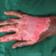 Quick-Tips-to-Treat-Fire-Burns-from-Crackers Quick Tips To Treat Fire Burns From Crackers