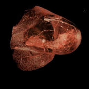 Brust_Computertomographie_mit_Kontrastmittel_Tumor Brust Computertomographie Mit Kontrastmittel Tumor