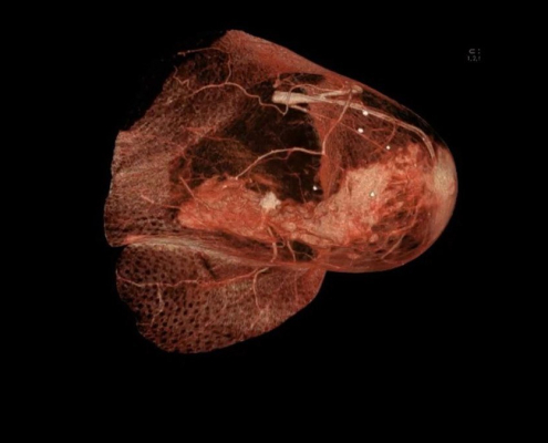 Brust_Computertomographie_mit_Kontrastmittel_Tumor Brust Computertomographie Mit Kontrastmittel Tumor