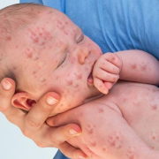 Baby Measles Vaccine