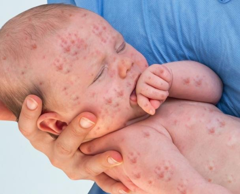 baby-measles-vaccine Baby Measles Vaccine