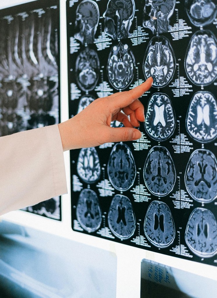 finger-pointing-to-a-brain-scan-stockpack-pexels.jpg Finger pointing to a brain scan