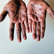 MPOX-480x459-1 Mpox 480x459 1
