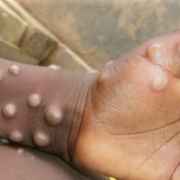 monkeypox Monkeypox
