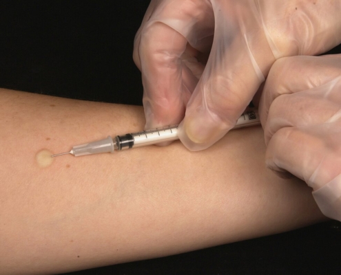 this-image-depicts-the-hands-of-a-clinician-that-were-in-the-process-of-correctly-placing-a-mantoux-tuberculin-skin-test-in-this-recipients-forearm-which-will-cause-a-6mm-to10mm-wheal-ie-a-raised-area-stockpack-unsplash.jpg This image depicts the hands of a clinician, that were in the process of correctly placing a Mantoux tuberculin skin test in this recipient’s forearm, which will cause a 6mm to10mm wheal, i.e., a raised area of skin surface, to form at the injection site. The Mantoux tuberculin skin test is used to evaluate people for latent tuberculosis (TB) infection. In the United States, this skin test consists of an intradermal injection of exactly one tenth of a milliliter (mL) of tuberculin, which contains 5 tuberculin units. Correct placement of this intradermal injection involves inserting the needle