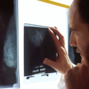 a-doctor-examines-mammograms-on-a-view-box-stockpack-unsplash.jpg A doctor examines mammograms on a view box.