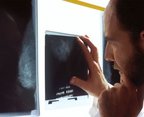 a-doctor-examines-mammograms-on-a-view-box-stockpack-unsplash.jpg A doctor examines mammograms on a view box.