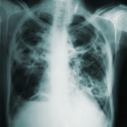 Pulmonary tuberculosis