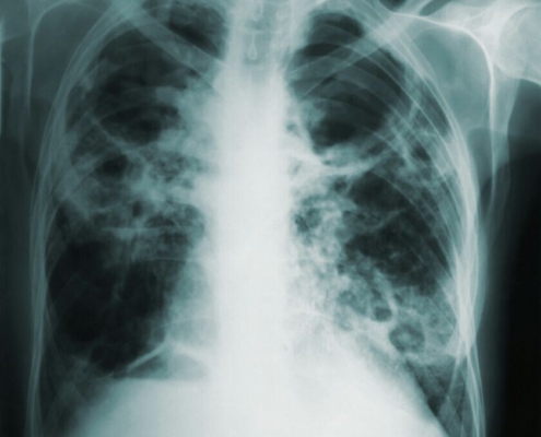 pulmonary-tuberculosis-stockpack-unsplash.jpg Pulmonary tuberculosis