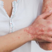 psoriasis, skin, disease, inflammation, scaly, skin disease, red, inflamed, patient, psoriasis, psoriasis, psoriasis, psoriasis, psoriasis, inflammation, skin disease, skin disease