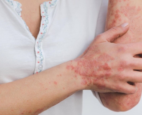 psoriasis-skin-disease-inflammation-scaly-skin-disease-red-inflamed-patient-stockpack-pixabay.jpg psoriasis, skin, disease, inflammation, scaly, skin disease, red, inflamed, patient, psoriasis, psoriasis, psoriasis, psoriasis, psoriasis, inflammation, skin disease, skin disease