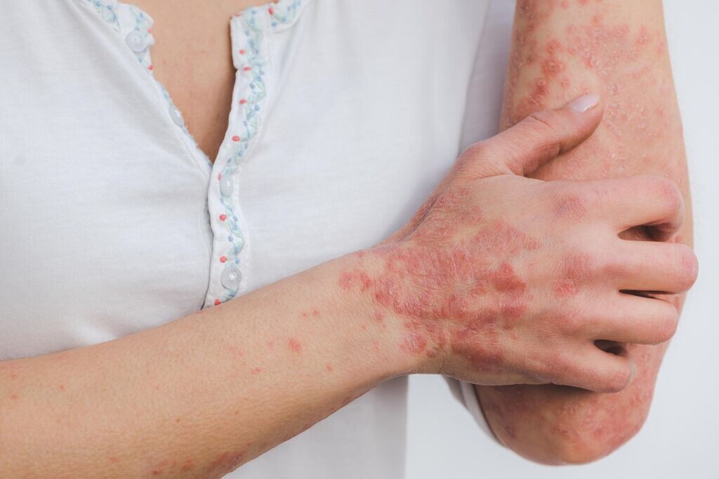 psoriasis-skin-disease-inflammation-scaly-skin-disease-red-inflamed-patient-stockpack-pixabay.jpg psoriasis, skin, disease, inflammation, scaly, skin disease, red, inflamed, patient, psoriasis, psoriasis, psoriasis, psoriasis, psoriasis, inflammation, skin disease, skin disease